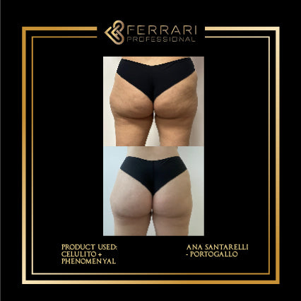 Mesoterapia Celulito 5x5ml
