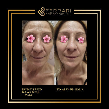 Mesoterapia Kolagenyal 5x5ml