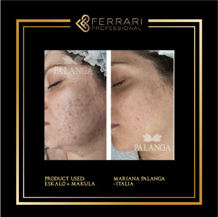 Peeling Eskalo 5x5ml