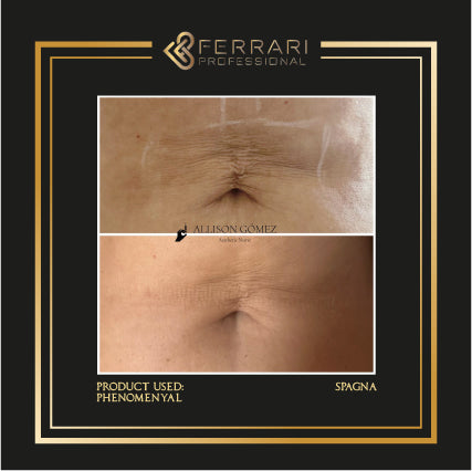 Mesotherapy Phenomena 5x5ml